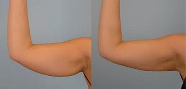 health tips in gujarati,flabby upper arms,tips to get rid of upper arm fat,Health tips