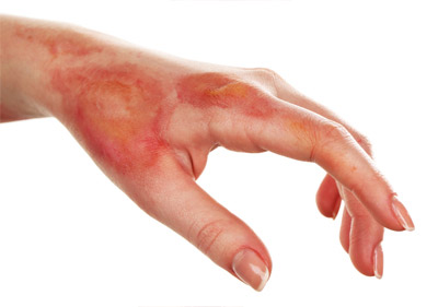 skin burnt,remedies for skin burnt,Health tips ,हेल्थ टिप्स, हेल्थ टिप्स हिंदी में, घरेलू उपचार, त्वचा की जलन के उपचार, जलने पर उपचार, प्राथमिक उपचार 