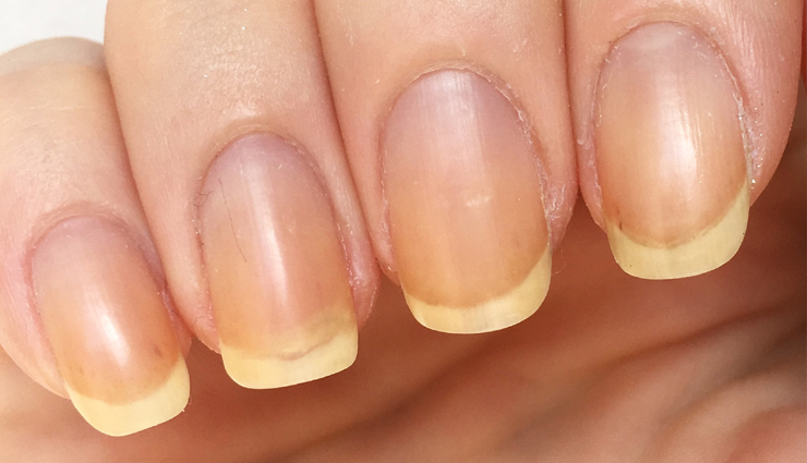 How to Identify and Treat Yellow Nails - wide 3