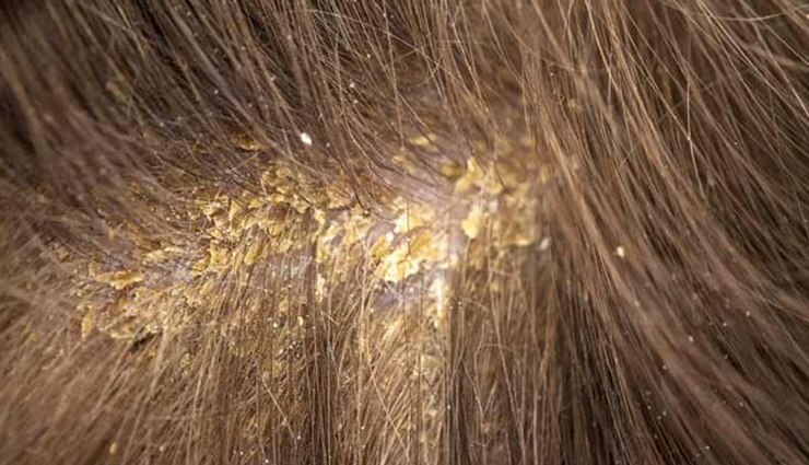 scalp scabs treatment,treating scabs on the scalp,get rid of scalp scabs,home remedies for scalp scabs,scalp care tips,scab removal methods,scalp health advice,healing scalp sores,natural remedies for scalp scabs,preventing scalp scabs