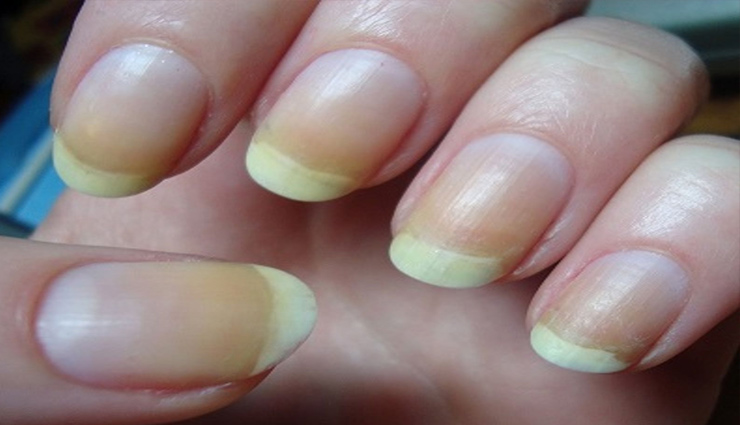 nails,diseases,nails diseases,nails shape,nails colour,jaundice,yellow nails,lines on nails,health article in hindi