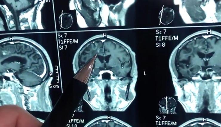 यह शख्श 30 साल से कर रहा था मिर्गी की दवाई का सेवन, सच्चाई पता चलने पर खिसक गई पैरों तले जमीन weird medical case,weird disease,china,worm lived in mans brain,mans causing headaches and seizures