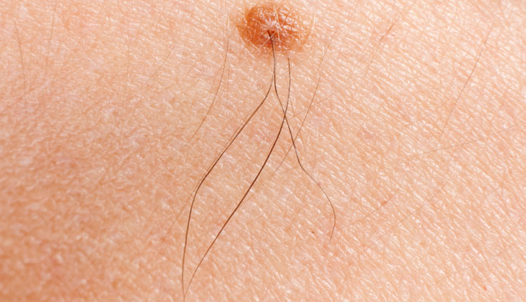 mole,black mole,brown mole,pigment melanin,mole on body,cancer,hair on mole,health article in hindi