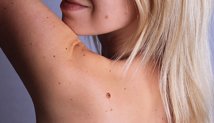 mole,black mole,brown mole,pigment melanin,mole on body,cancer,hair on mole,health article in hindi