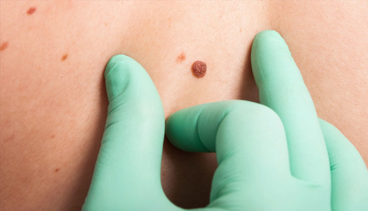 mole,black mole,brown mole,pigment melanin,mole on body,cancer,hair on mole,health article in hindi
