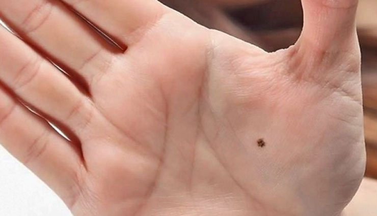 mole,black mole,brown mole,pigment melanin,mole on body,cancer,hair on mole,health article in hindi