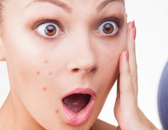 5 Ways To cure Pimples