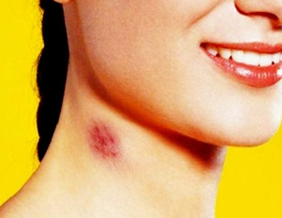 Health,Health tips,love bite,hickey,ecchymosis,how to remove a hickey,home ...
