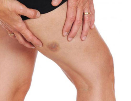 turmeric,5 disadvantages of using turmeric,side effects of turmeric