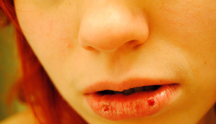 chapped lips,lips,home care lips,dry lips,bite,gulab ki pankhidiya,honey,aloe vera juice,water,crack lips,beauty article in hindi