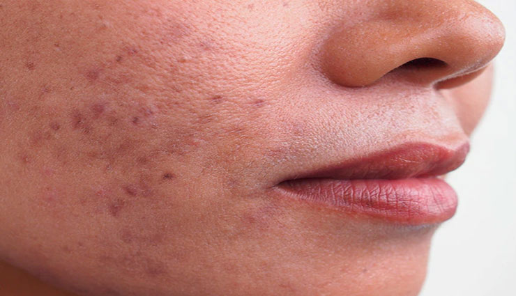 aloe vera gel,aloe vera,aloe vera benefits,aloe vera advantages,acne,sunburn,hair,swelling,health and beauty article in hindi