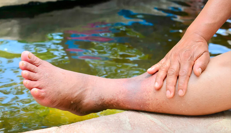 बारिश के मौसम में पैरों के साथ ‘चलती’ हैं ये समस्याएं, ऐसे रखें ख्याल... legs,rainy season,legs rainy season,infection,nails,eczema,barefoot,rain,health news in hindi