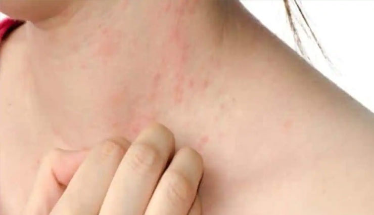 skin allergy,skin allergy reasons,skin allergy symptoms,skin allergy home tips,immunity,rashes,itch,pimples,neem aloe vera,health article in hindi