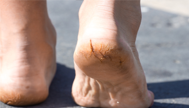 water chestnut,singhara,water chestnut benefits,water chestnut medicinal value,health news in hindi