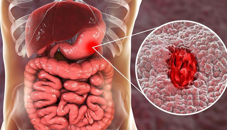 स्पाइसी फूड का नाम सुनते ही ललचाता है मन! करना होगा काबू, क्योंकि पैदा होती हैं ये परेशानियां... spicy food,spicy food side effects,oily food,spicy food health,stomach pain,loose motion,heart,teeth,health article in hindi