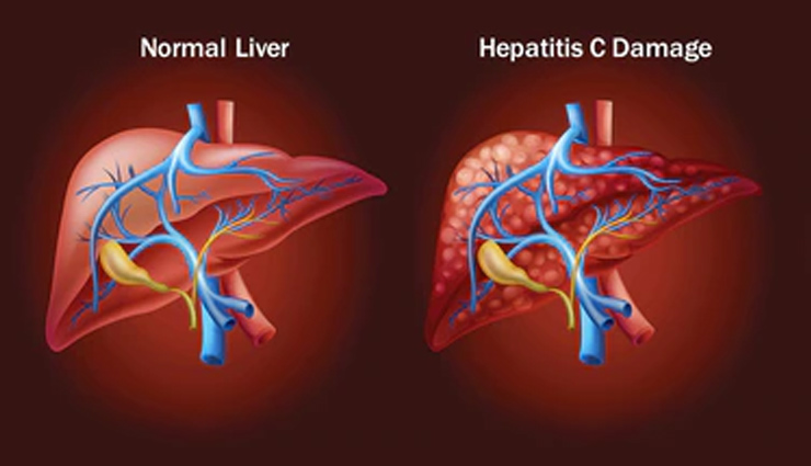 hepatitis,liver,hepatitis disease,hepatitis a,hepatitis b,hepatitis c,hepatitis d,hepatitis e,food,virus,health article in hindi