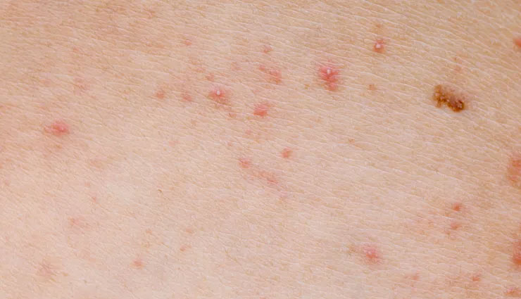 aloe vera gel,aloe vera,aloe vera benefits,aloe vera advantages,acne,sunburn,hair,swelling,health and beauty article in hindi