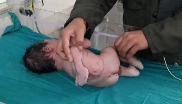 baby born with 4 hands 4 legs,bihar,katihar,sadar hospital,new born baby,baby girl born with 4 legs and 4 hands surgery,weird news