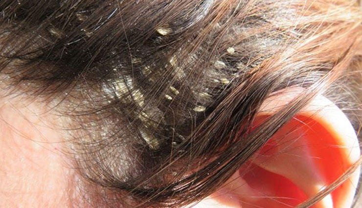 curd,hair,skin,yogurt,curd skin,curd hair,curd health,dandruff,skin care,hair care,beauty article in hindi