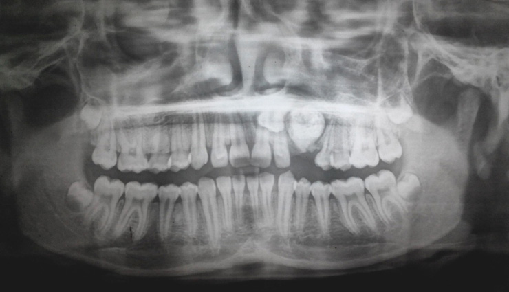 इंदौर:  Odontoma बीमारी से ग्रसित था 10 साल का ये बच्चा, डॉक्टरों ने उखाड़े 30 दांत
