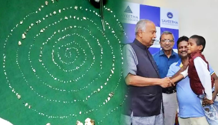 चेन्नई : डॉक्टरों ने 7 साल के बच्चे के मुंह से निकाले 526 दांत, 5 घंटे चला ऑपरेशन 