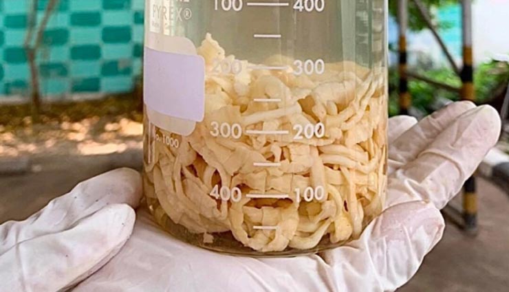 शख्स के प्राइवेट पार्ट से निकला 59 फीट लंबा कीड़ा, डॉक्टर्स भी रह गए हैरान