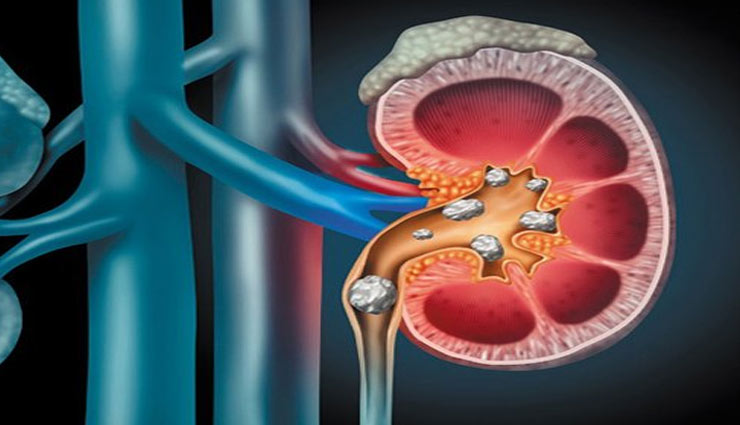 coconut water,nariyal pani,coconut water benefits,coconut water health,coconut,kidney stone,headache,pregnant lady,health article in hindi