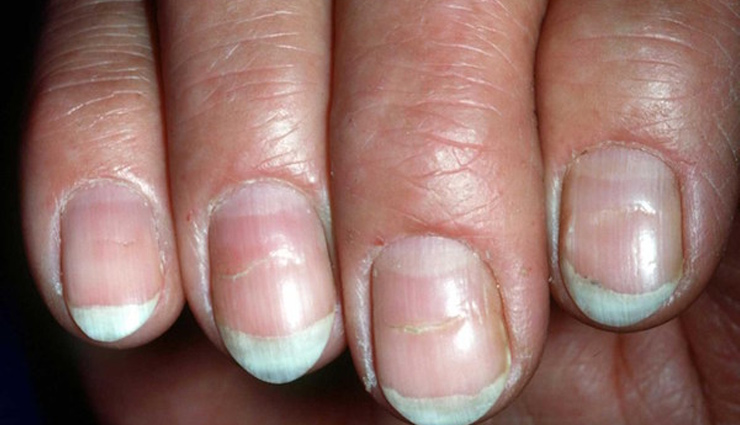 nails,diseases,nails diseases,nails shape,nails colour,jaundice,yellow nails,lines on nails,health article in hindi