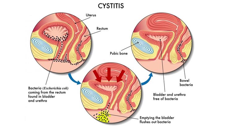 healthy benefits in hindi,symptoms and treatment of urine infection