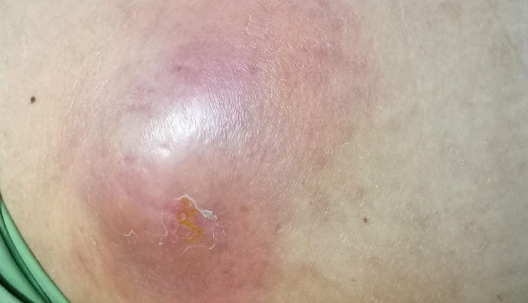 7 Home Remedies for Treating Boils and Abscesses