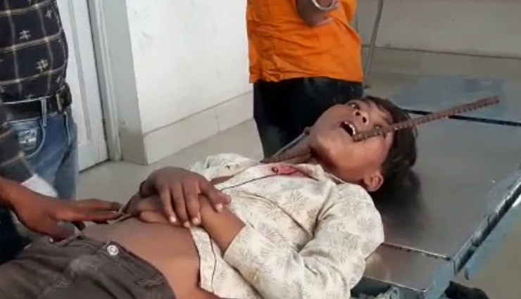 लॉकडाउन में हादसा / लोहे की छड़ों पर गिरा किशोर, जबड़े के आर-पार हुआ सरिया