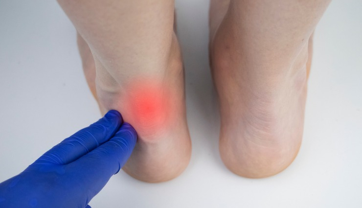 achilles tendon pain remedies,home remedies for achilles tendon pain,natural treatments for achilles tendon pain,effective remedies for achilles tendonitis,how to treat achilles tendon pain at home,relieve achilles tendon pain naturally,achilles tendon pain home treatments,remedies for achilles heel pain,home care for achilles tendinitis,diy remedies for achilles tendon pain