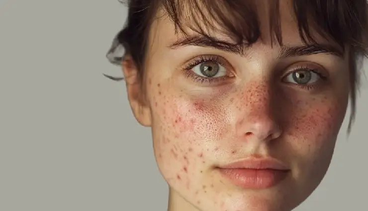 multani mitti benefits,fuller’s earth for skin,multani mitti for hair,natural remedies for acne,diy face packs,oil control face mask,skin brightening with multani mitti,dandruff control natural remedy,natural hair cleanser,chemical-free beauty tips