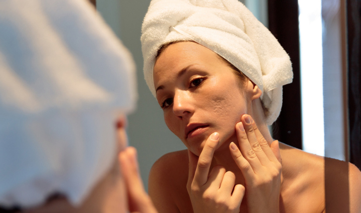 acne breakout,reasons for acne breakout,acne,skin care tips,beauty tips,summer tips