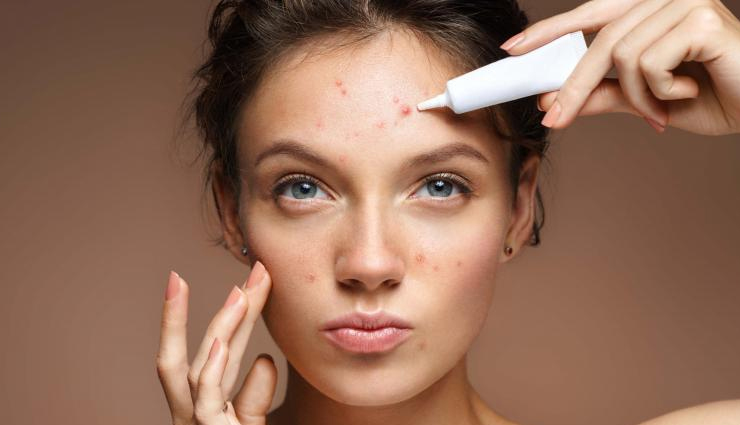 home remedies,home remedies for acne,skin care tips,beauty tips
