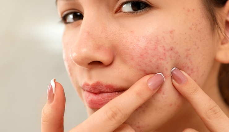 5 DIY Ways To Use Rose Water To Acne at Home
