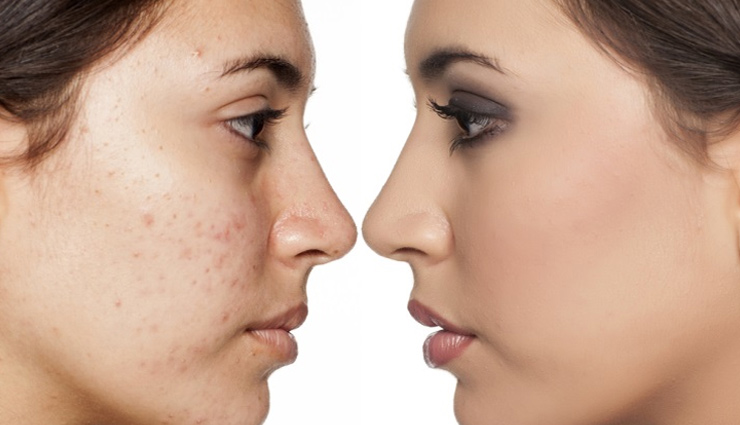 beauty,beauty tips,acne,black spots,smooth skin,glowing skin,sensitive skin,soft and glowing skin,chicken pox scars,simple beauty tips