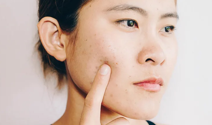 5 Reasons You are Having an Acne Breakout