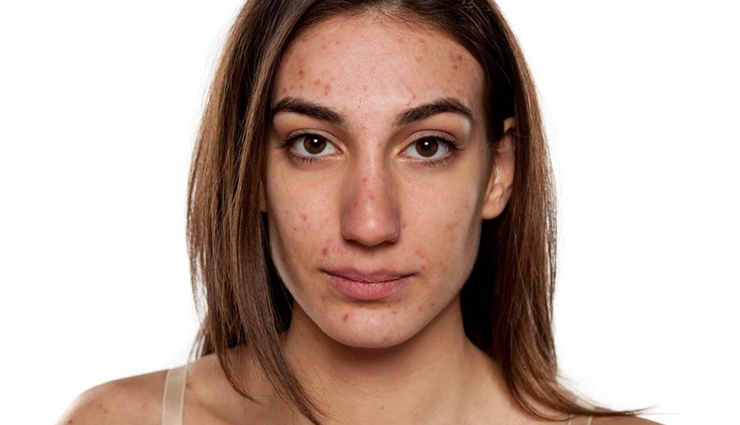 Different Ways To Use Baking Soda To Get Rid of Acne