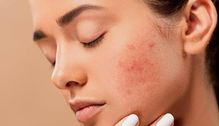 4 Ayurvedic Paste To Cure Acne Without Any Medicine