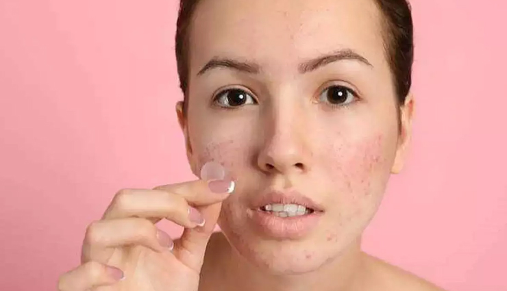 5 Simple Remedies To Treat Acne and Pimples
