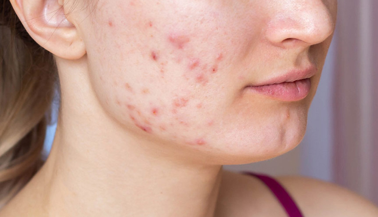 diy ways to use coconut oil to treat acne scars,beauty tips,beauty hacks