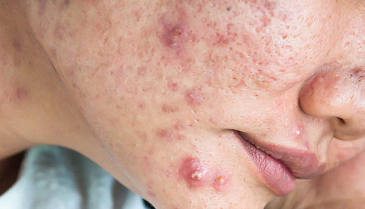 Understanding Acne: Causes and 10 Foods You Should Avoid
