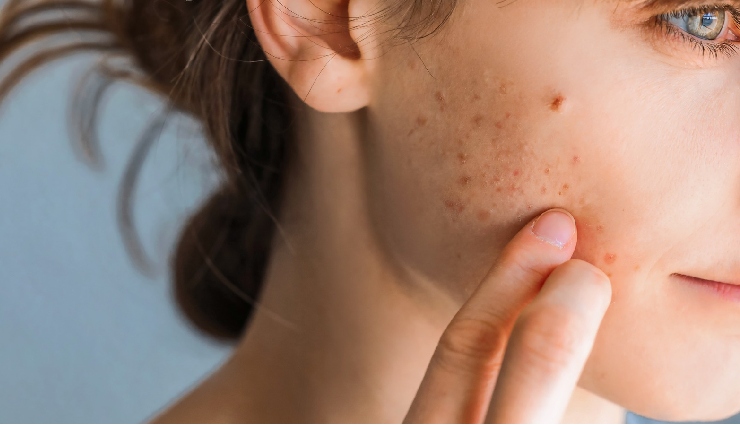 6 Foods That Causes Acne Breakouts