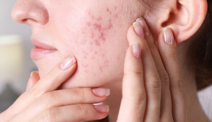 summer skin care,summer skin mistakes,protecting skin from sun,acne prevention summer,managing sweat skin,uv protection tips,healthy skin summer,summer skincare routine,avoid skin damage summer,skincare in humid climate