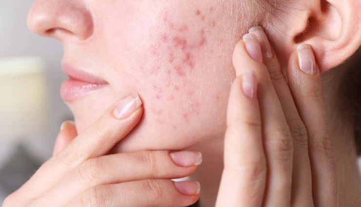 facial peels benefits,how to use facial peels,natural facial peels,skin lightening peels,peels for dark spots,peels for tanning,even skin tone tips,chemical peel at home,best peels for glowing skin,face peel for blemishes