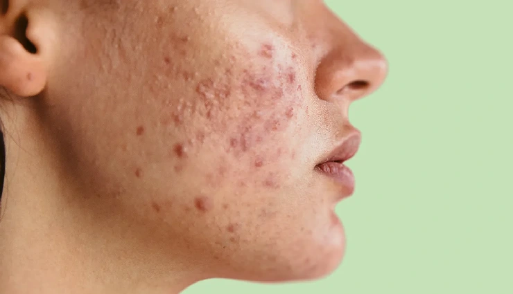 benefits of walnuts for skin,walnuts for glowing skin,walnut skincare benefits,anti-aging with walnuts,natural skincare ingredients,walnuts for hydration,how walnuts help skin,walnut face pack,exfoliating with walnuts,skin nutrition from walnuts