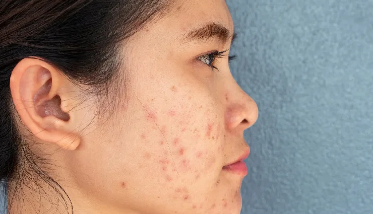 4 Ways To Use Olive Oil To Treat Acne Scars
