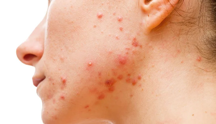 honey for skin,benefits of honey for skin,honey skincare remedies,natural moisturizer honey,honey for glowing skin,acne treatment with honey,home remedies for healthy skin,honey face mask,honey for dry skin,natural skin care ingredients