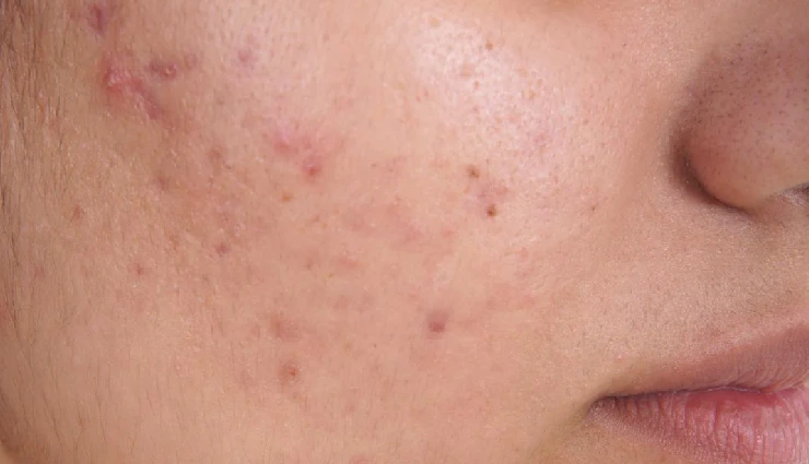 banana for skin,banana beauty benefits,diy banana face mask,banana for glowing skin,banana skincare remedies,banana peel benefits for skin,natural skin brightening tips,banana for dry skin,home remedies for healthy skin,banana face scrub